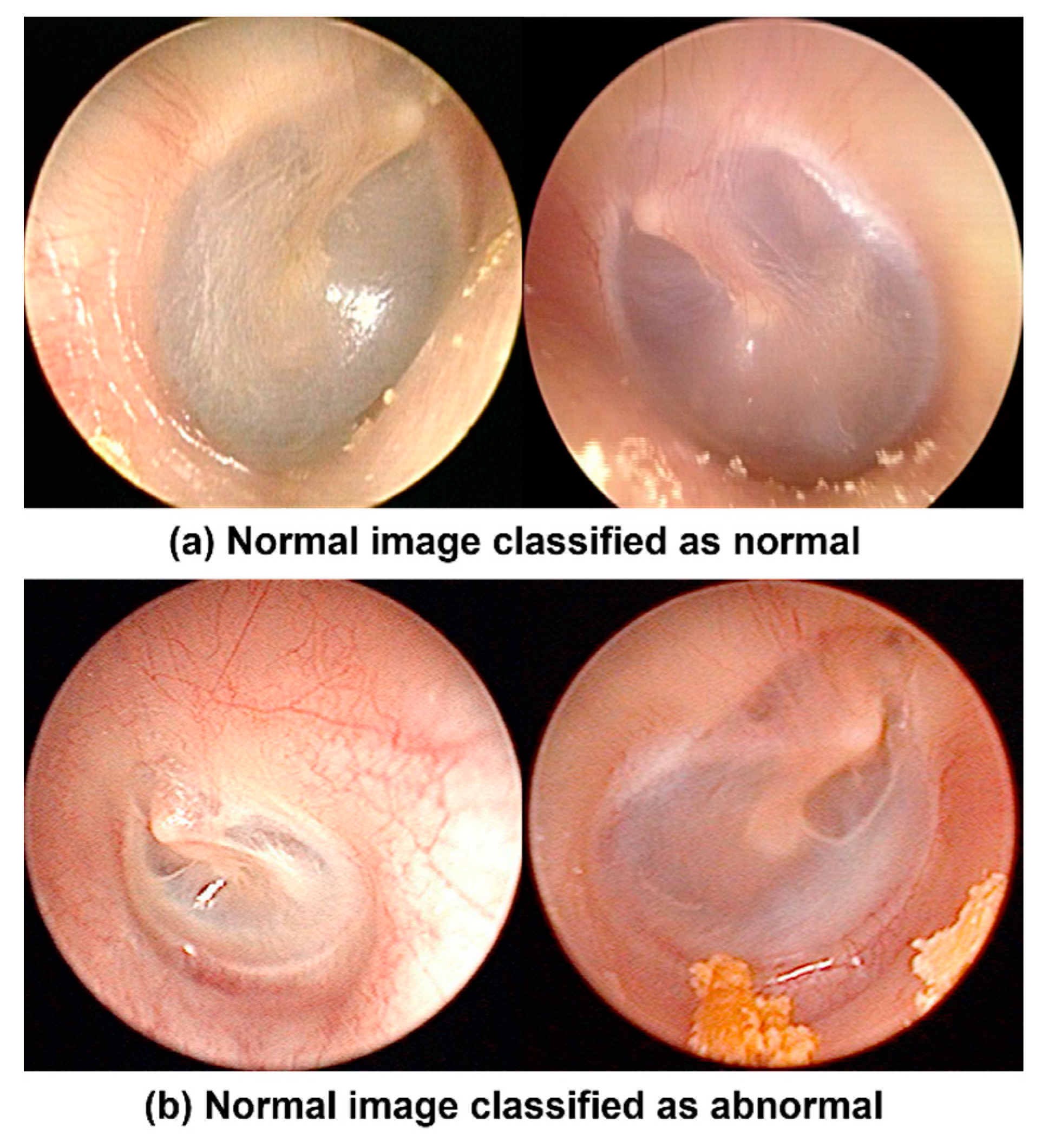 Applied Sciences | Free Full-Text | Semantic Decomposition and Anomaly  Detection of Tympanic Membrane Endoscopic Images