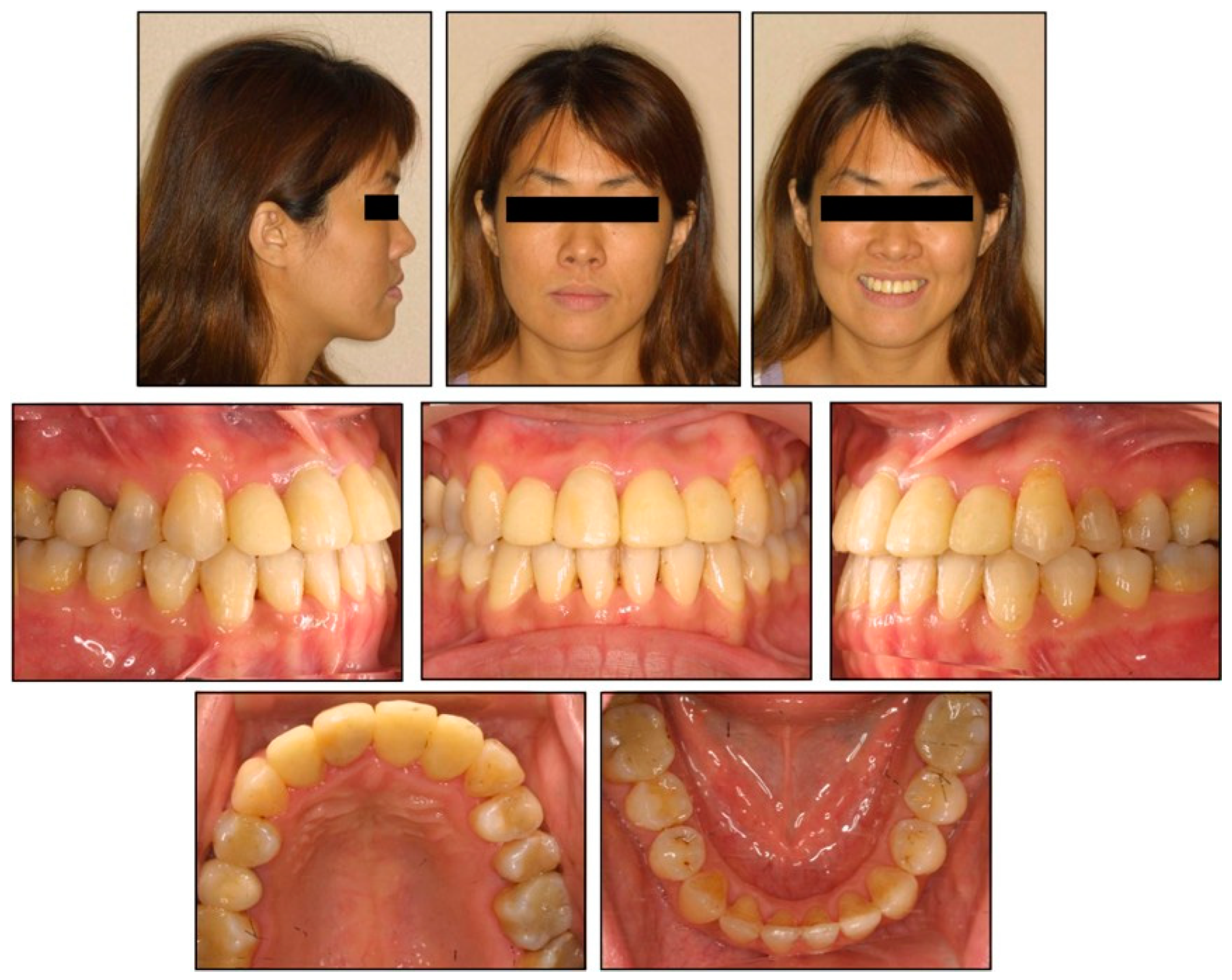 Applied Sciences | Free Full-Text | Nonsurgical Correction of Anterior  Crossbite with Extra-Radicular Miniscrews&mdash;A Case Report