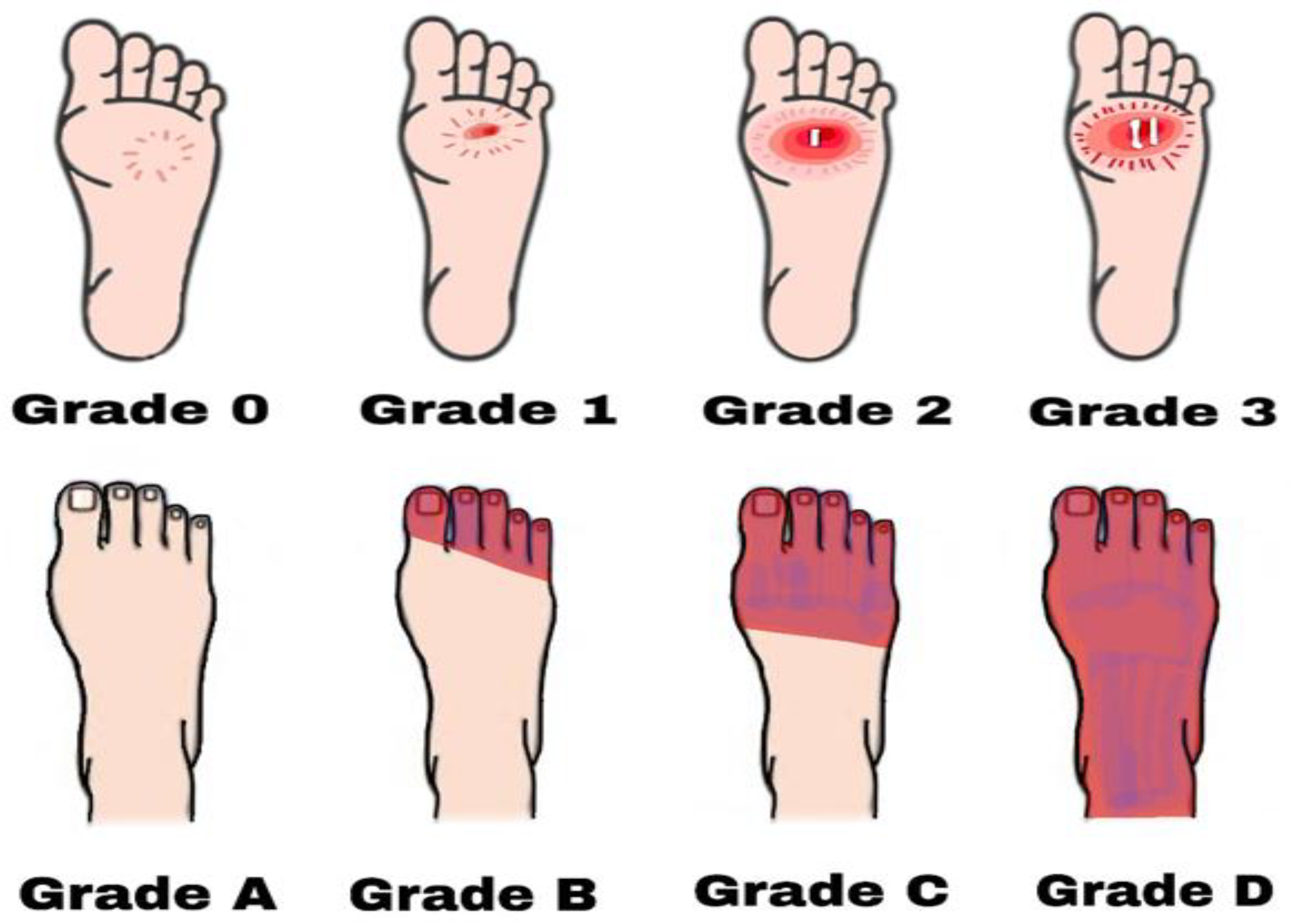 TELEHEALTH and Foot Health in Diabetes – Foot Forward