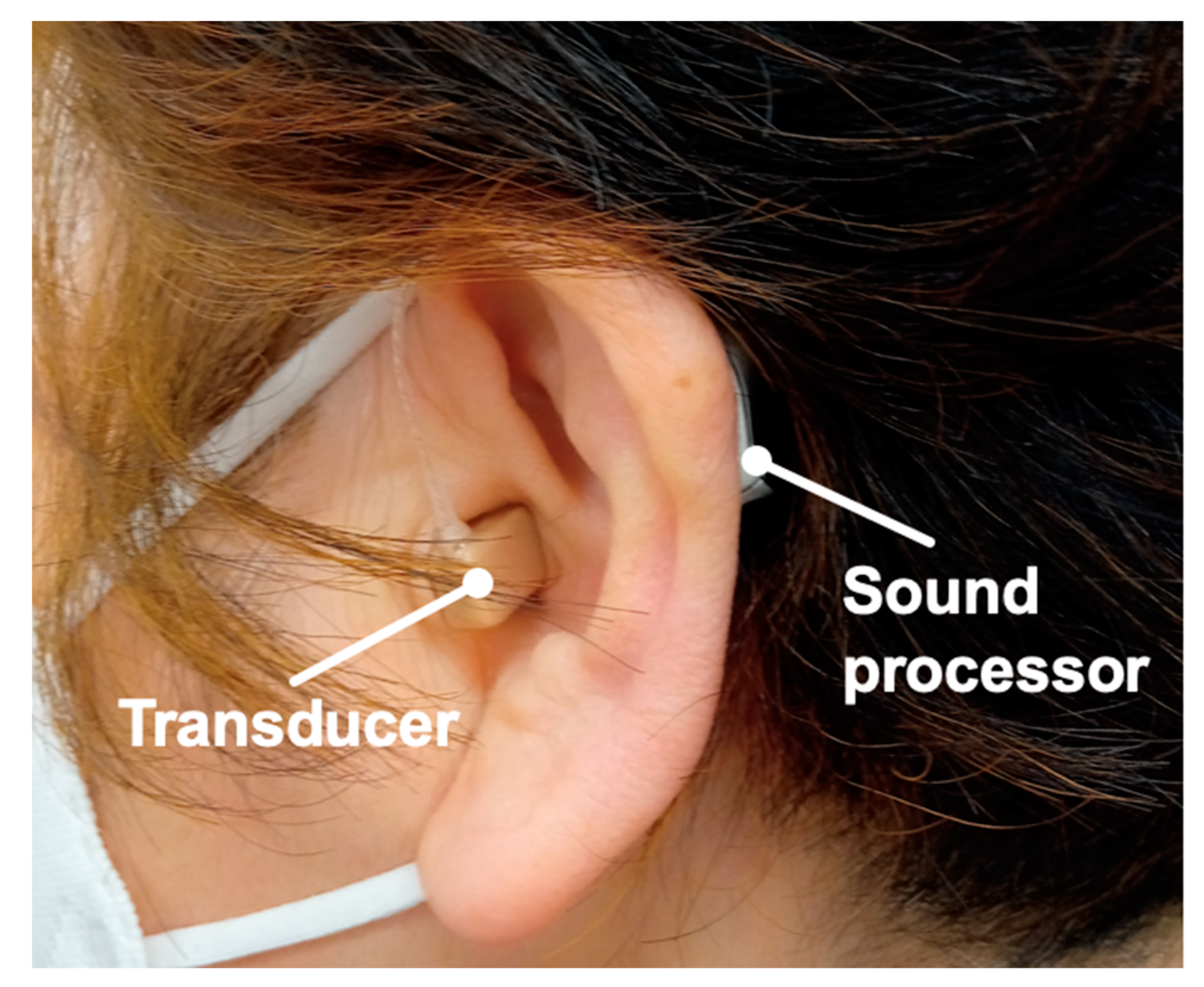 Applied Sciences Free Full-Text Comparison of Cartilage Conduction Hearing Aid, Bone Anchored Hearing Aid, and ADHEAR Case Series of 6 Patients with Conductive and Mixed Hearing Loss image image