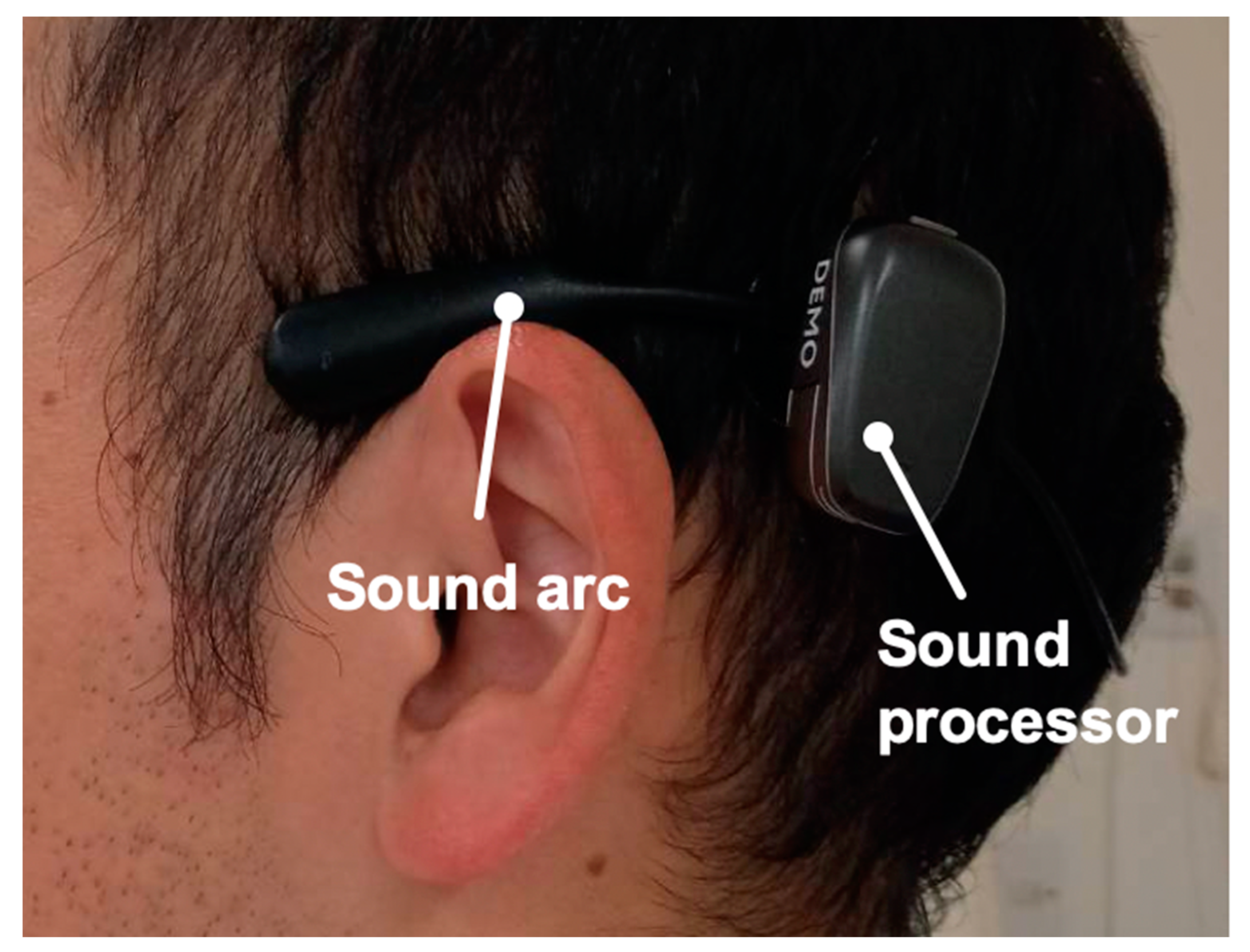 Applied Sciences Free Full-Text Comparison of Cartilage Conduction Hearing Aid, Bone Anchored Hearing Aid, and ADHEAR Case Series of 6 Patients with Conductive and Mixed Hearing Loss