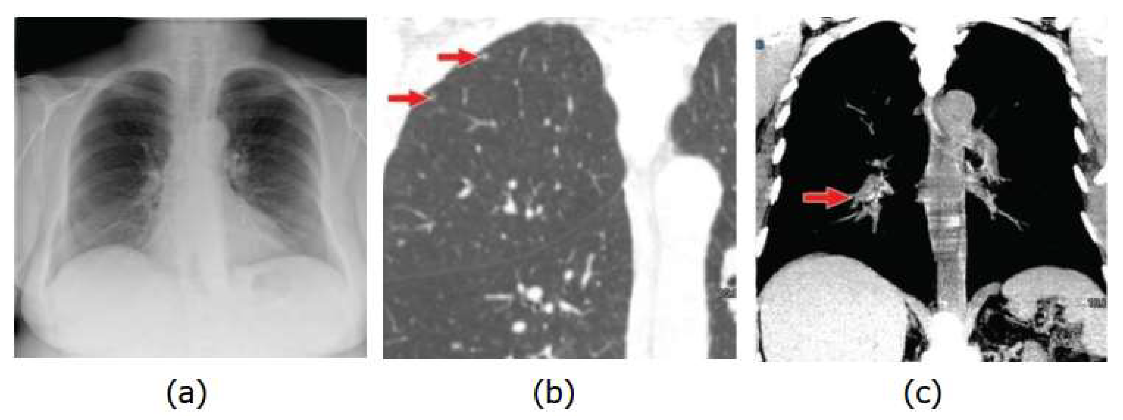 Lung Nodules Localization and Report Analysis from Computerized ...