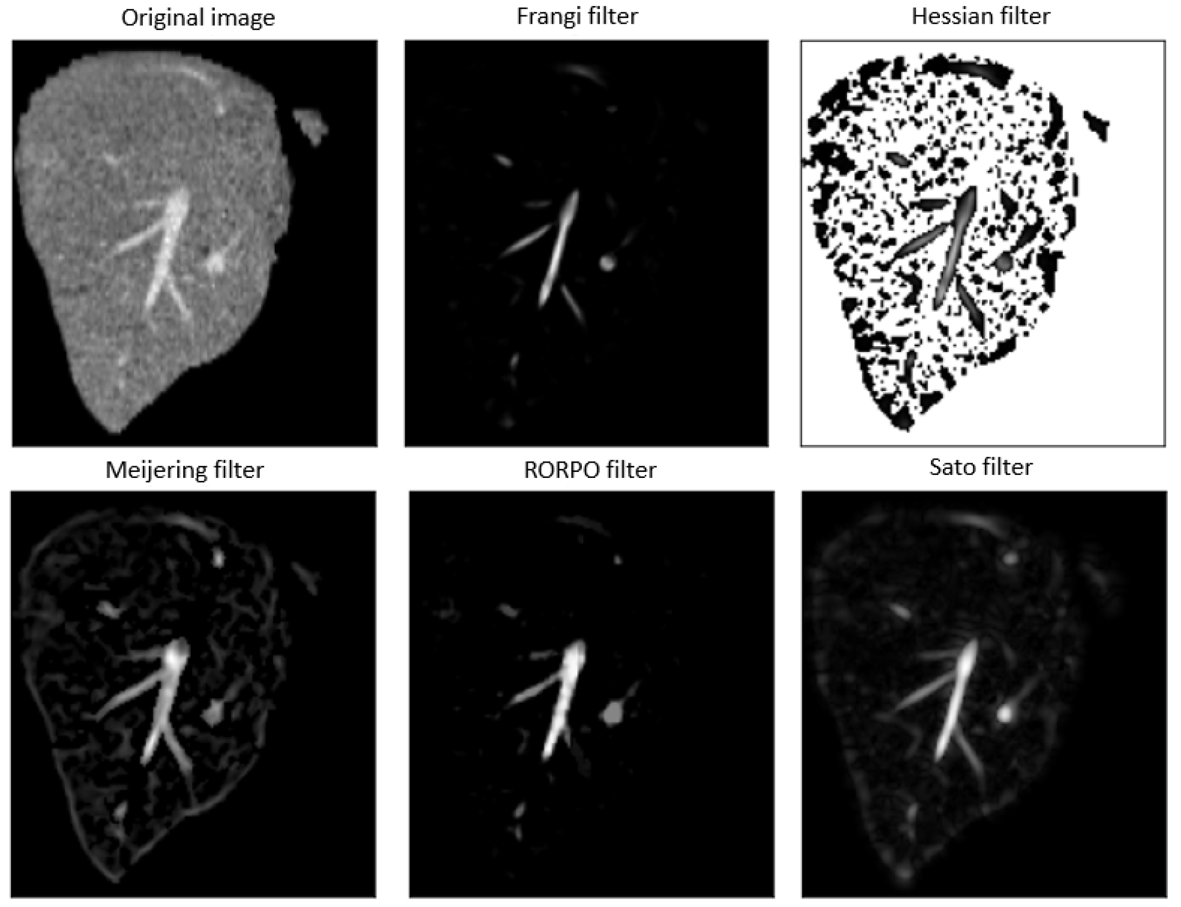 Automatic Hepatic Vessels Segmentation Using RORPO Vessel Enhancement ...