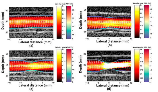 Wall Shear Stress Measurement in Carotid Artery Phantoms with Variation ...