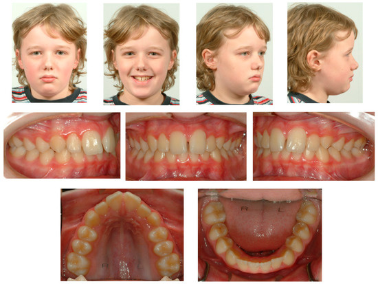 Overlay wires - Biomechanical Institute for Orthodontics