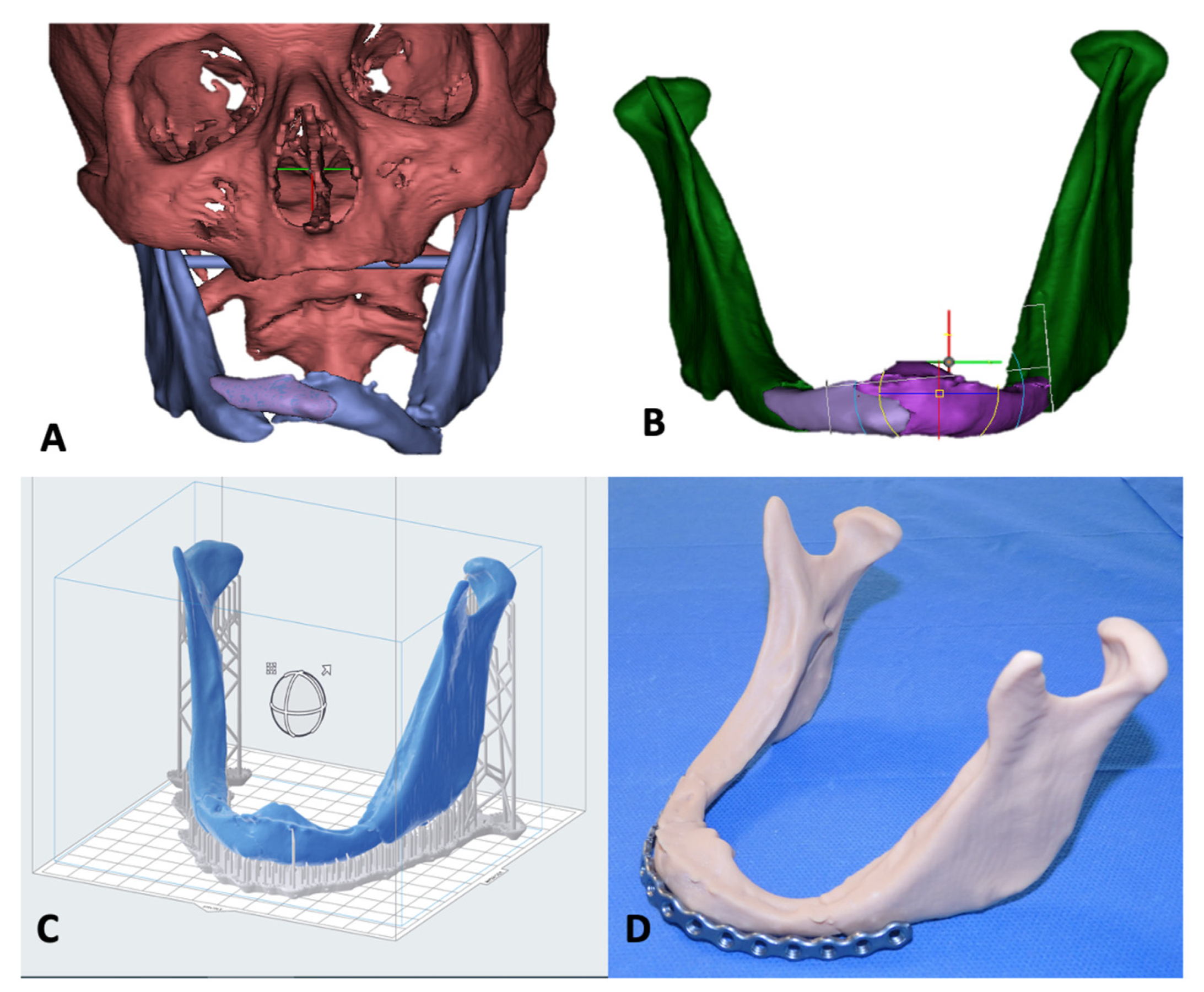 Mandible