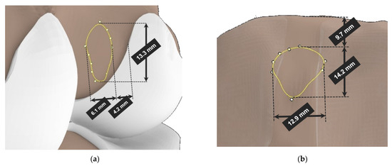 Revisiting the Role of Knee External Rotation in Non-Contact ACL ...