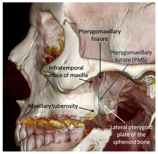Applied Sciences | Free Full-Text | Characterization of Pterygomaxillary  Suture Morphology: A CBCT Study
