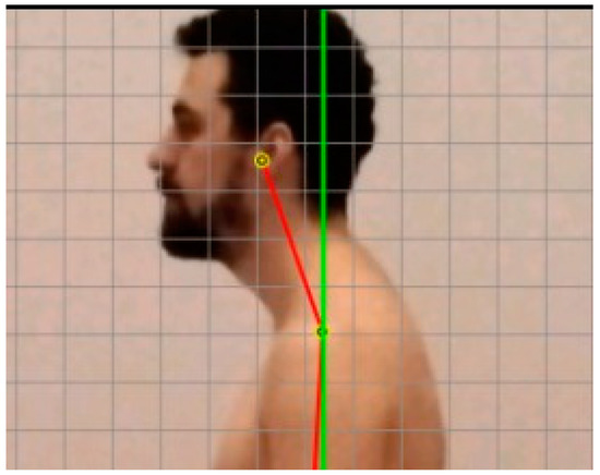 Pillow for sales forward head posture