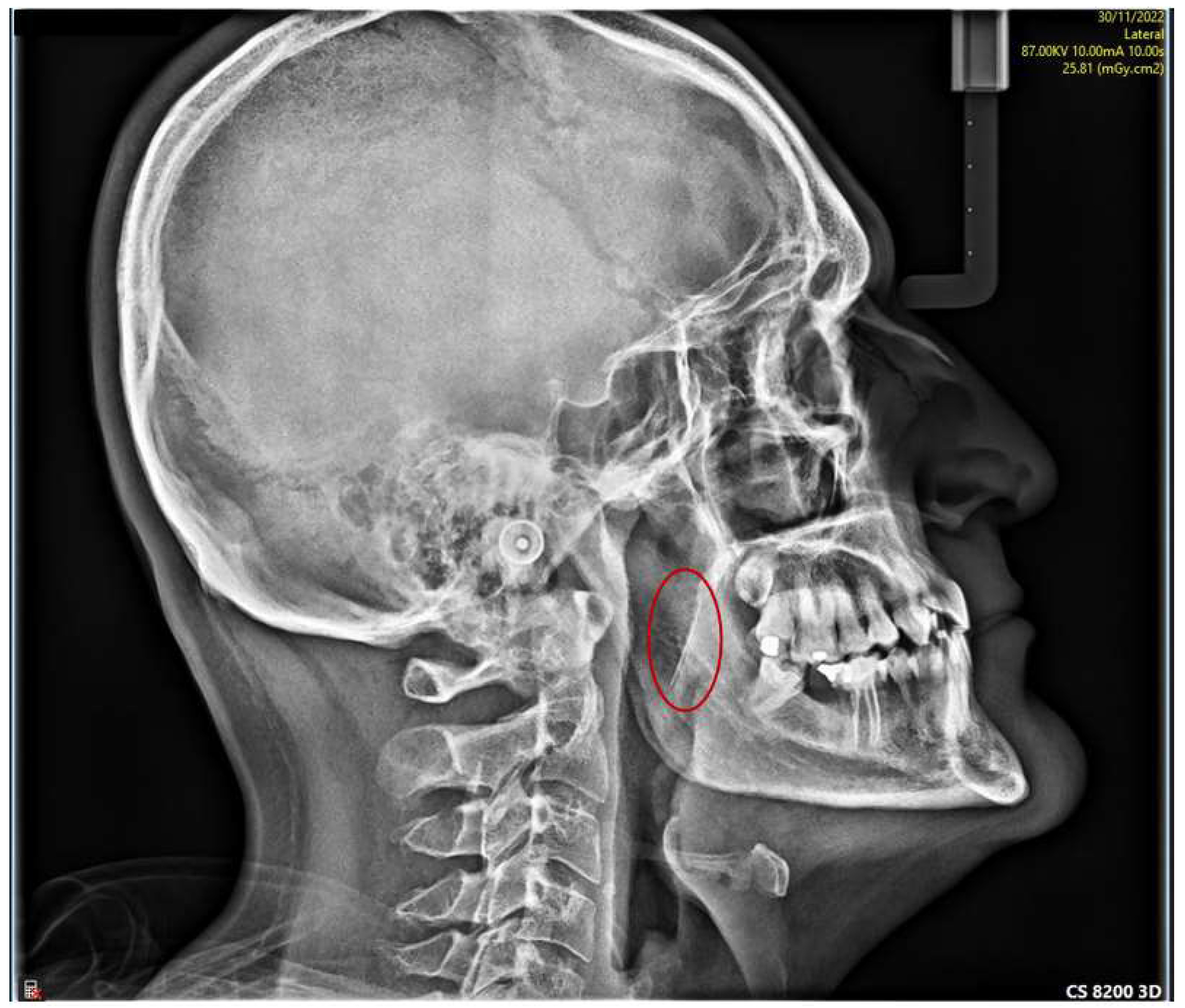 Applied Sciences Free FullText Needle Fracture in