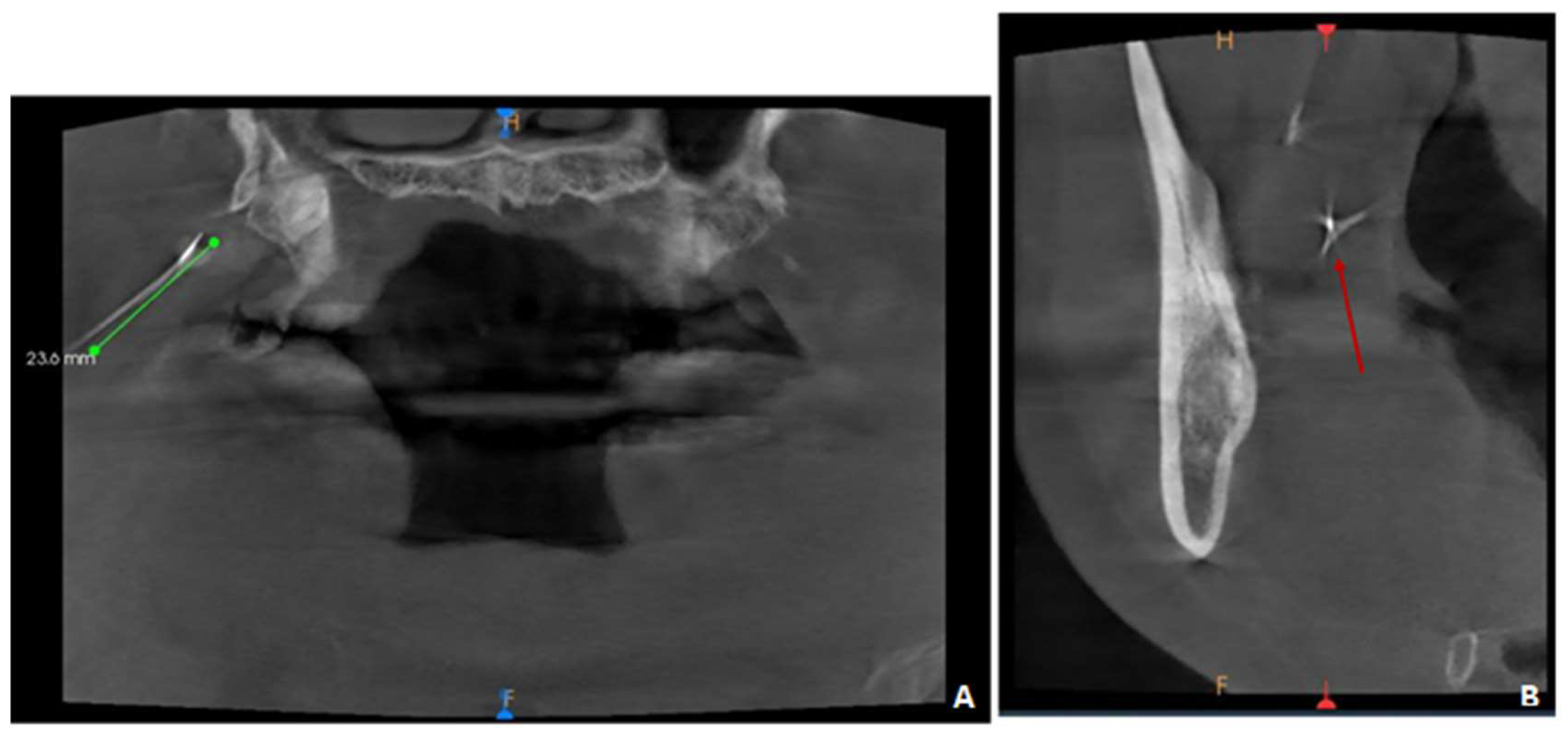 Applied Sciences Free FullText Needle Fracture in