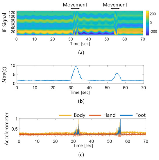 Polysomnography - Wikipedia