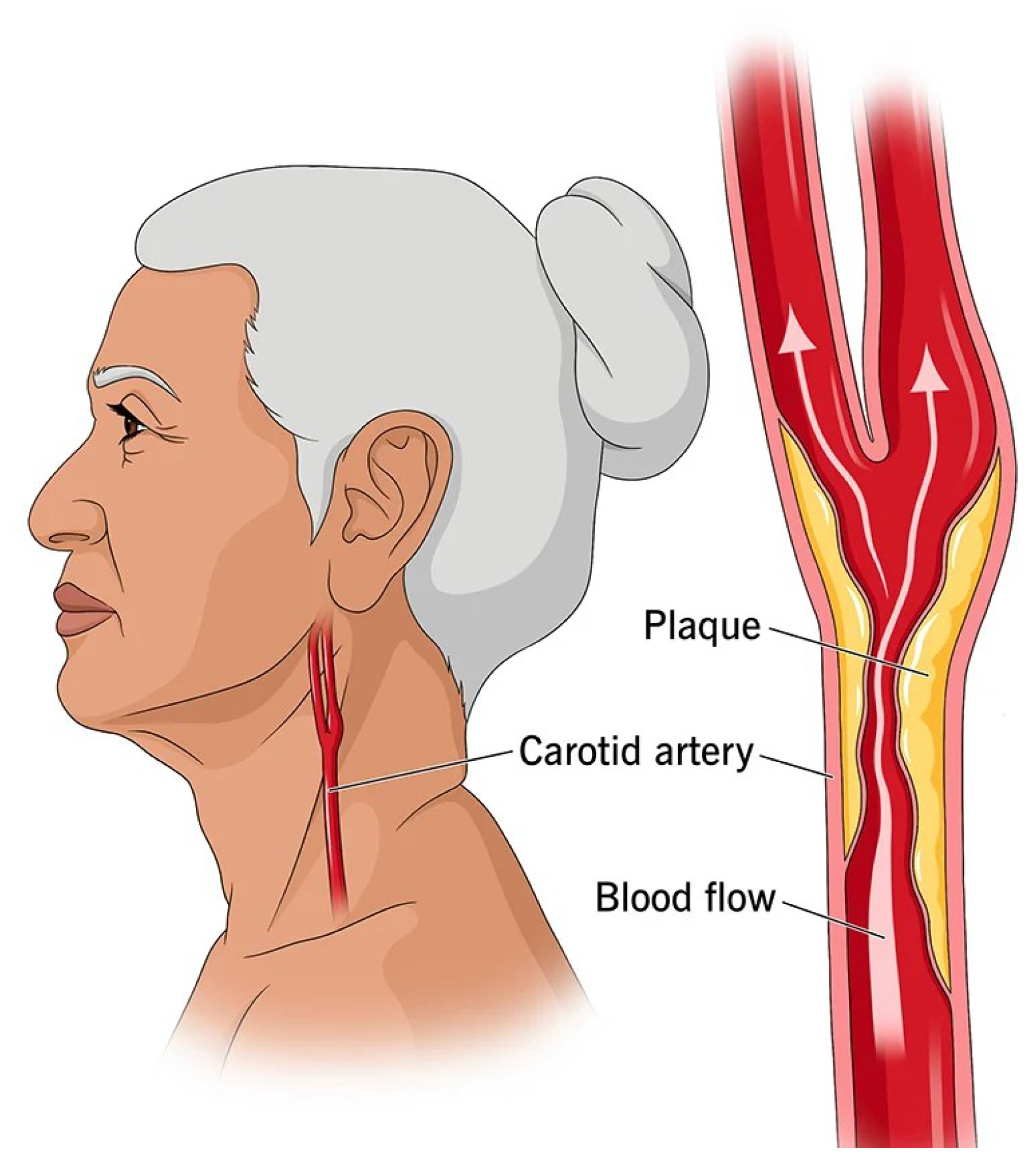 Pictures Of Scars From Carotid Artery Surgery - fy4w8de