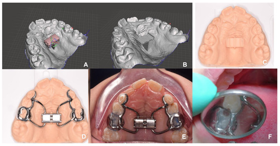 From Reverse Engineering Software to CAD-CAM Systems: How Digital ...