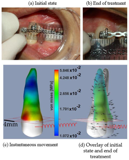 An Efficient Spring Model for an Integrated Orthodontic Tooth Movement ...