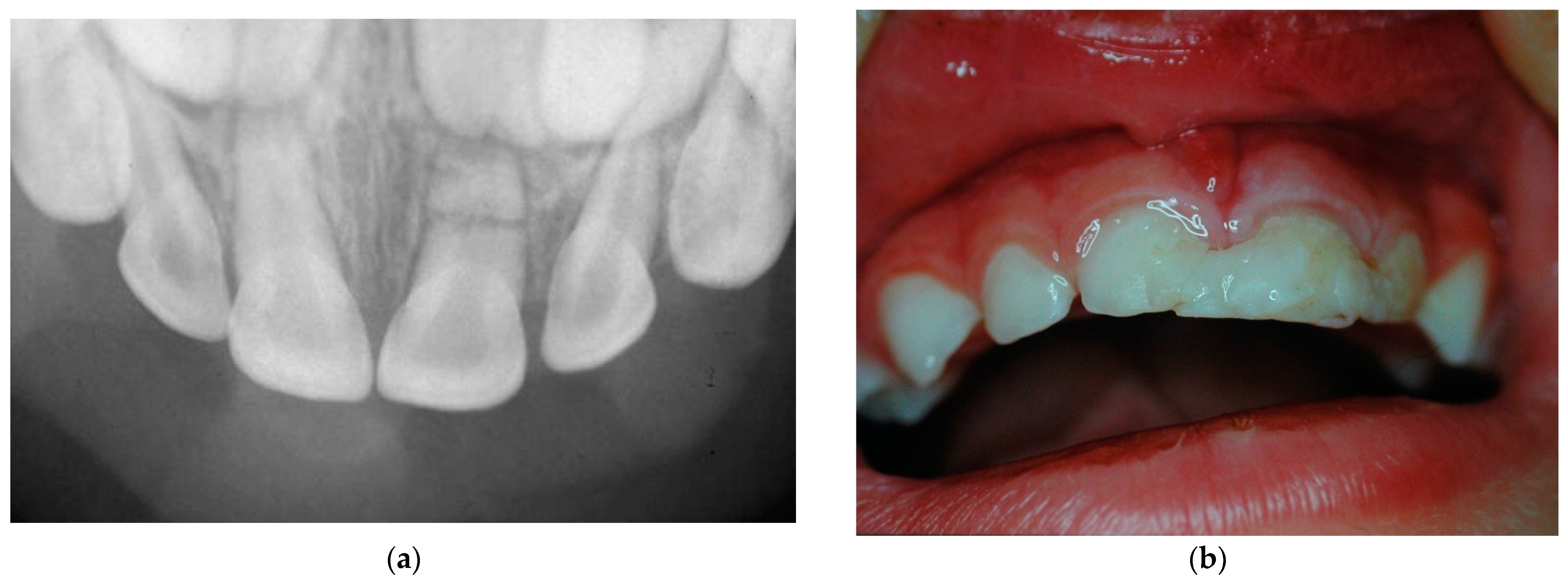 Sex Full Hd 15to18year Zoom - Applied Sciences | Free Full-Text | A Retrospective Cohort Study of  Traumatic Root Fractures in Primary Dentition: Can Splinting Type Improve  Therapeutic Outcomes?