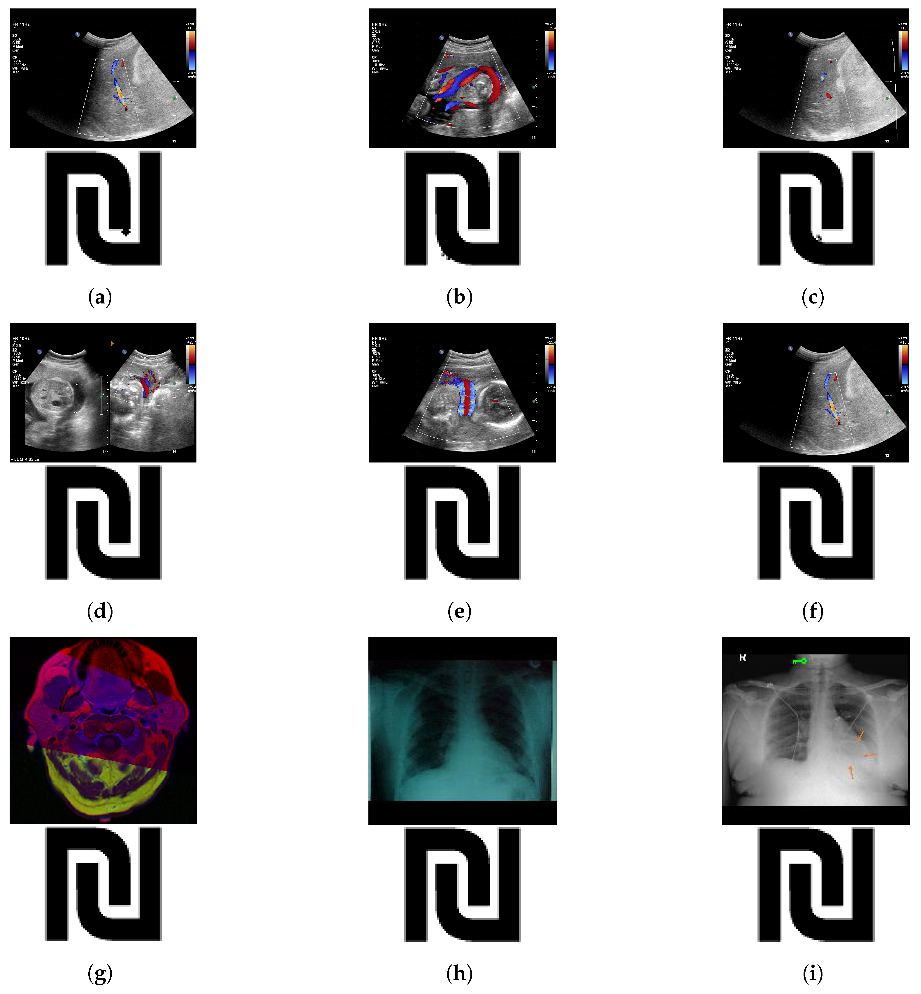 Robust Medical Image Watermarking Scheme Using PSO, LWT, and Hessenberg ...