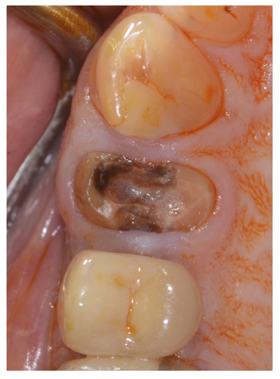 Applied Sciences Free FullText Modified Periosteal Inhibition (MPI