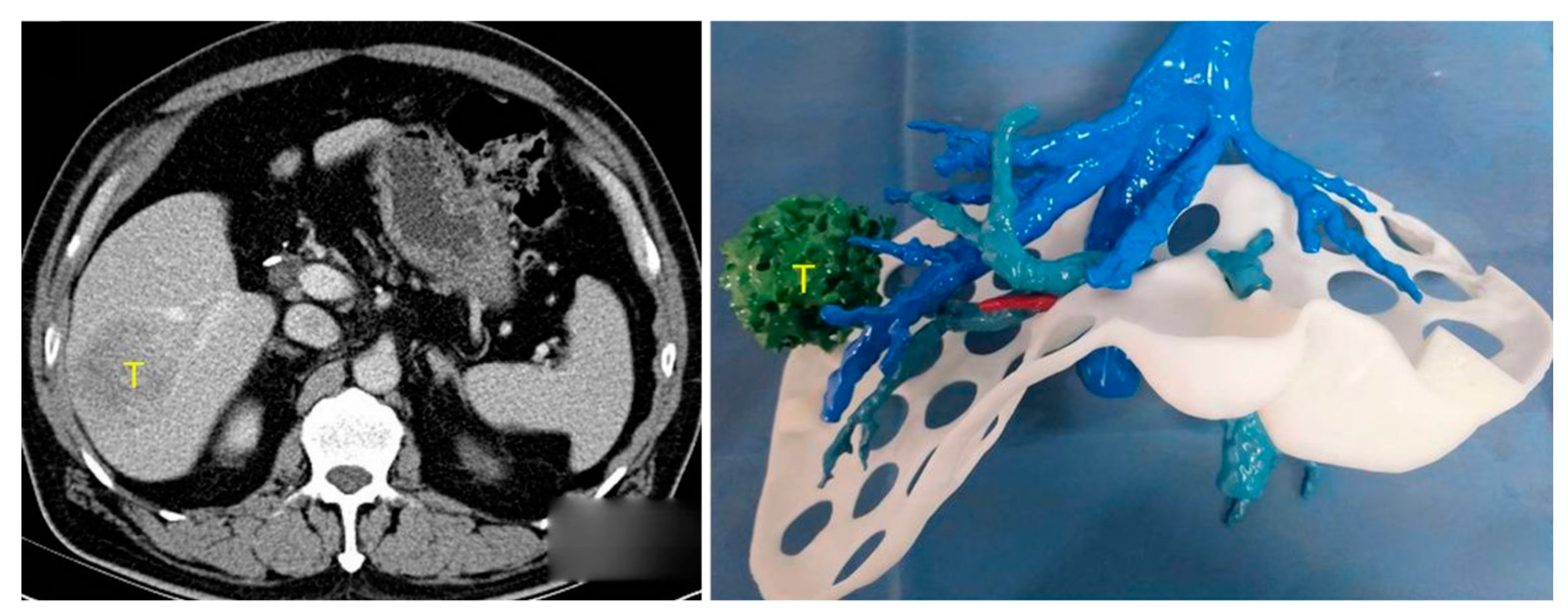 Three-Dimensional Printed Liver Models for Surgical Planning and 