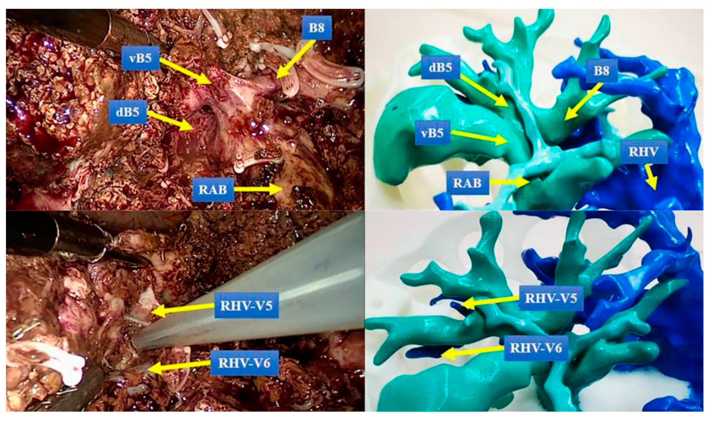 Three-Dimensional Printed Liver Models for Surgical Planning and 