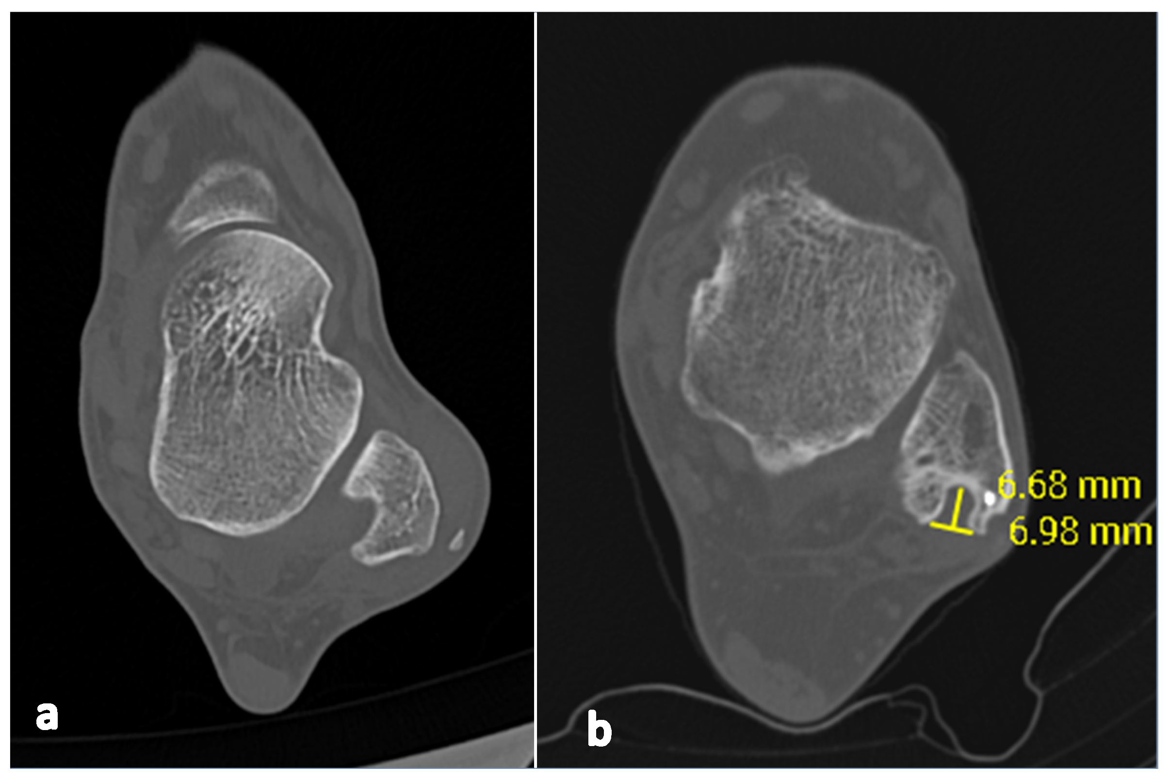 Applied Sciences Free FullText Retromalleolar Groove Deepening in Recurrent Peroneal Tendon