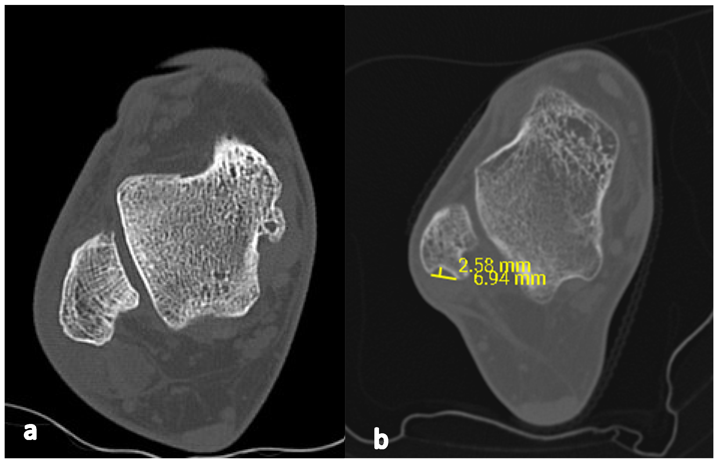 Applied Sciences Free FullText Retromalleolar Groove Deepening in