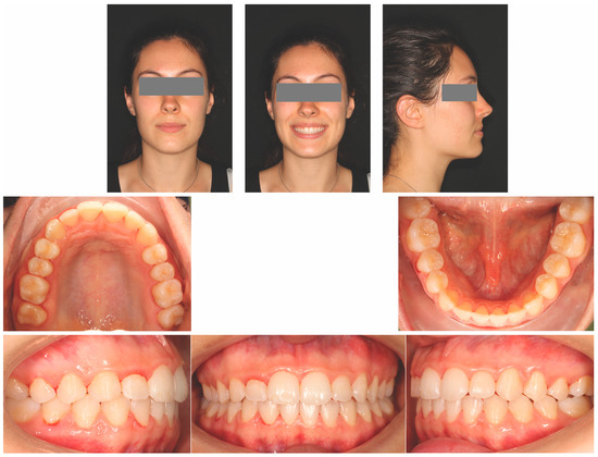 Open Bite Treatment with Combined Aligners and Myofunctional