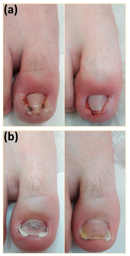 Clinical appearance of the elevated nail and the protruding mass. |  Download Scientific Diagram