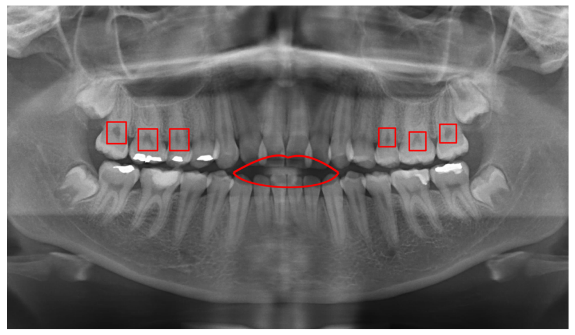 Applied Sciences Free FullText Detection of Cavities from Dental
