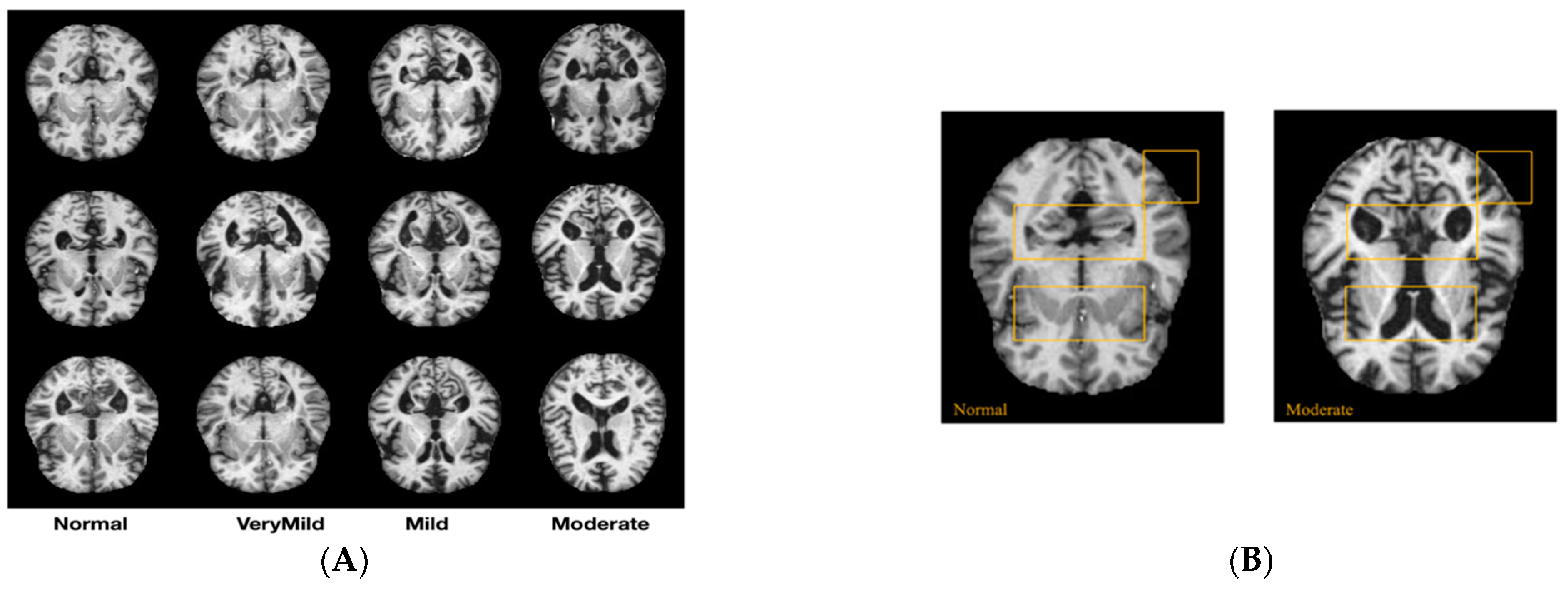 Novel Deep-Learning Approach for Automatic Diagnosis of Alzheimer’s ...