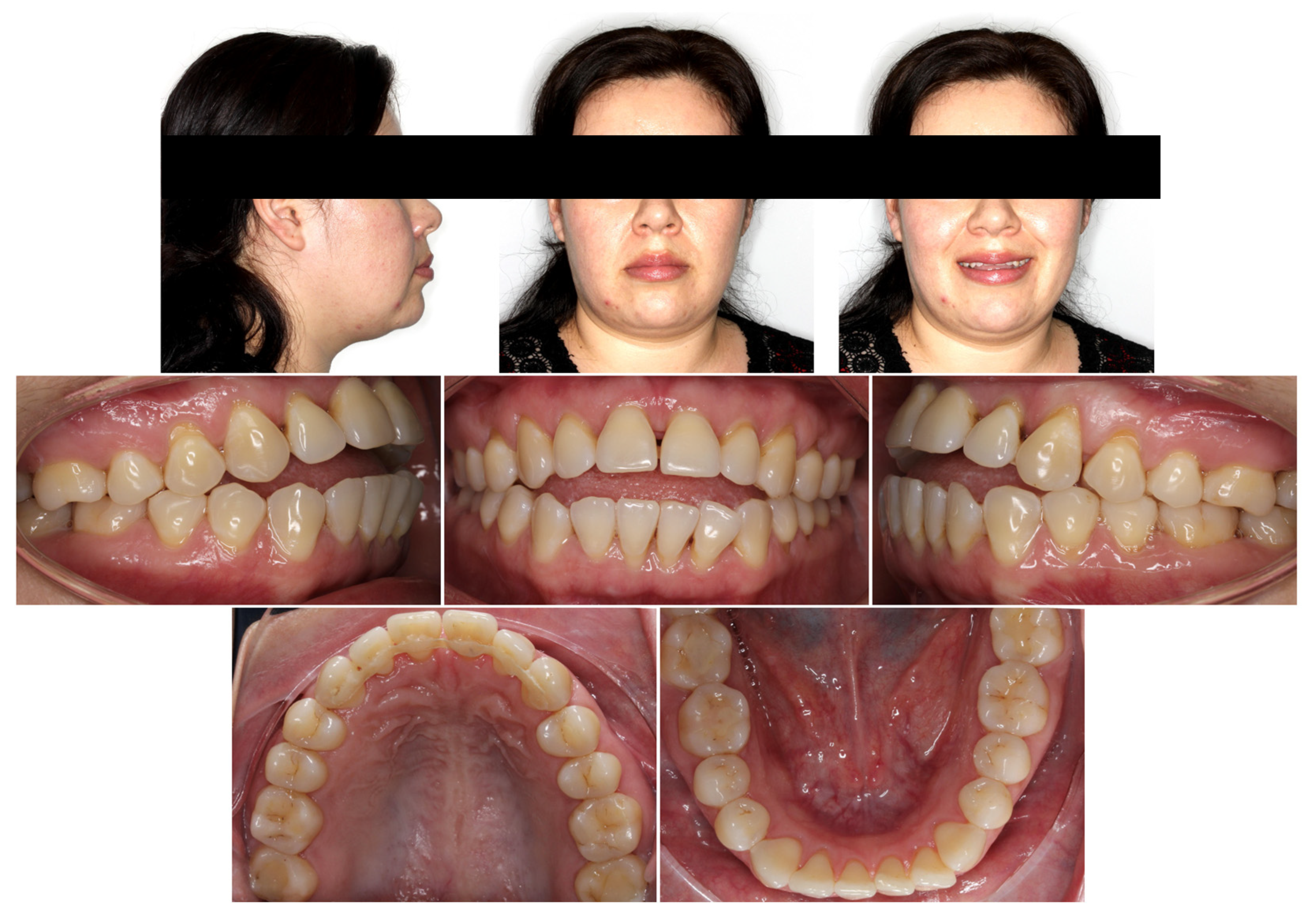 Orthodontic Correction of an Anterior Open Bite with Periodontally 