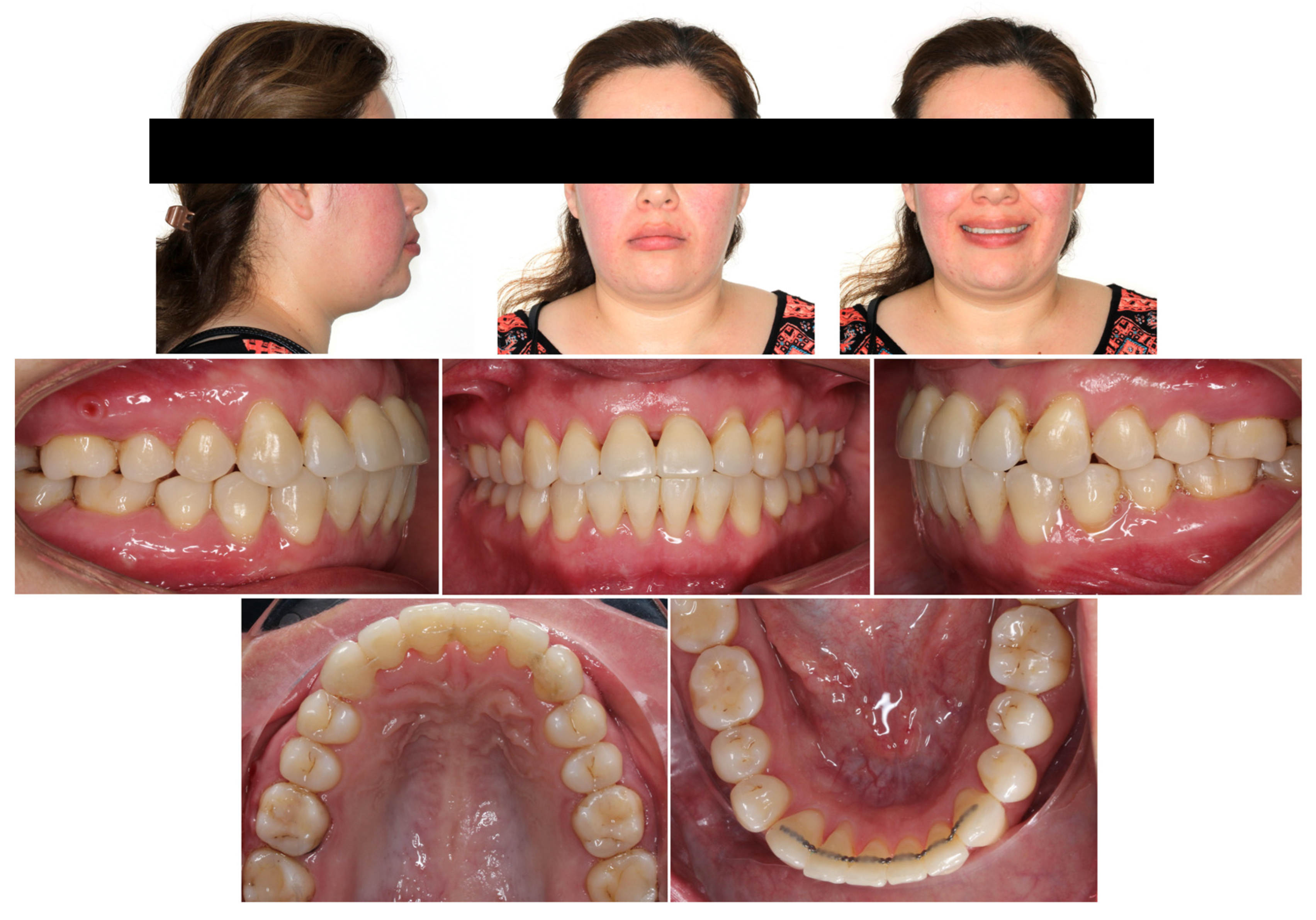 Orthodontic Correction of an Anterior Open Bite with Periodontally 