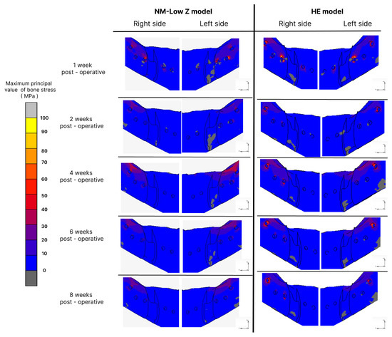 Finite Element Analysis of Mandibular Advancement Comparing