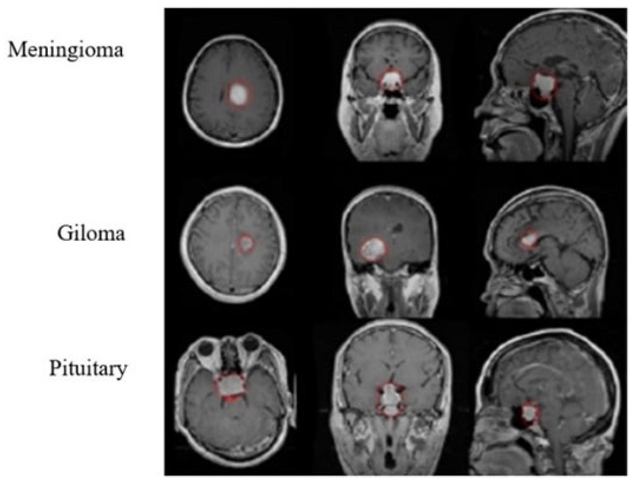 Applied Sciences | Free Full-Text | Automated Brain Tumor ...