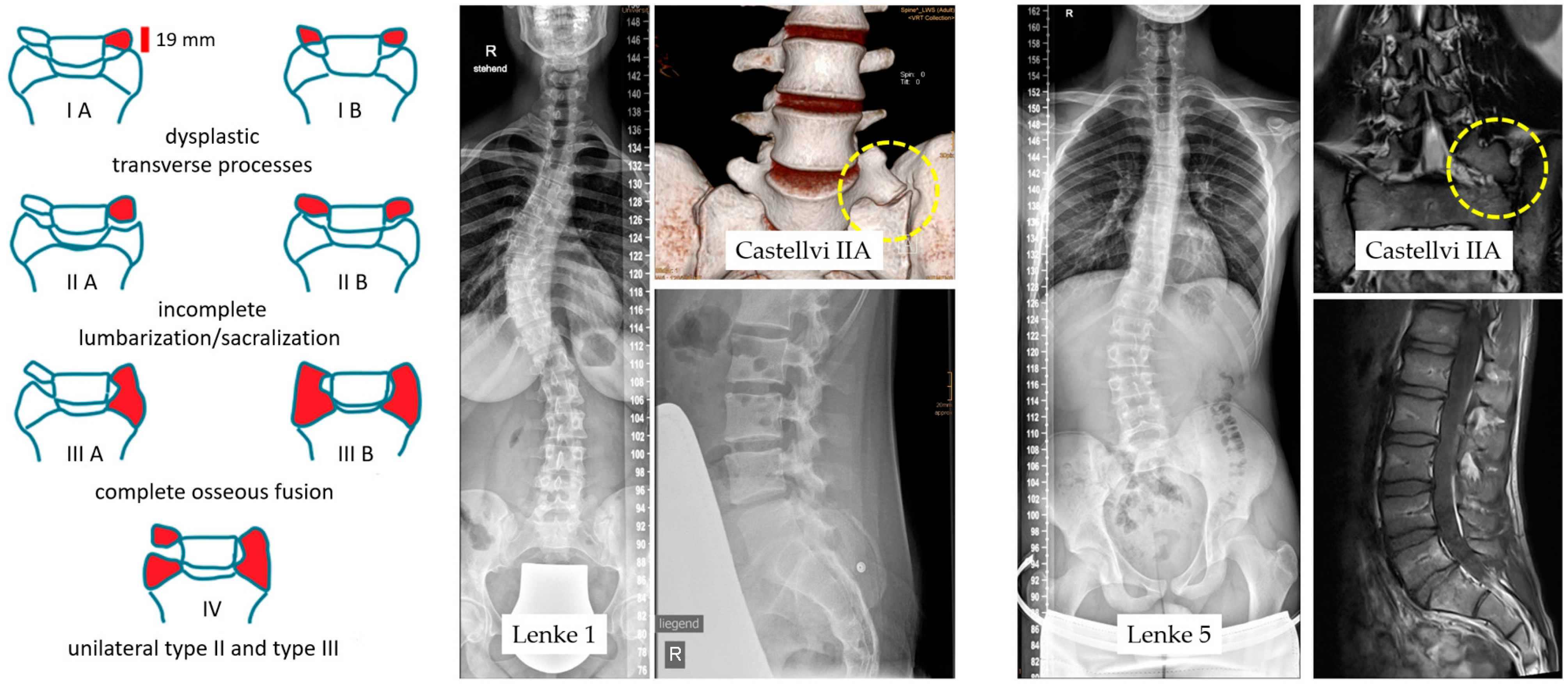 Lumbosacral Transitional Disorder as a Missing Link in