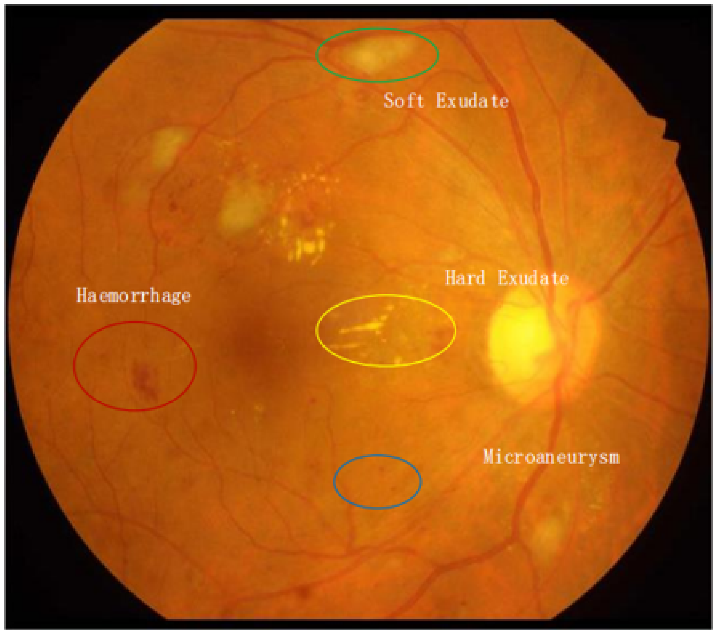 Lightweight Frequency Recalibration Network for Diabetic