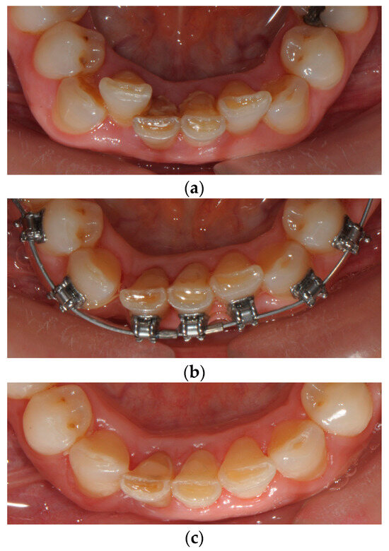 PEEK Retainers without CAD-CAM: Simple Solutions for Everyday Challenges
