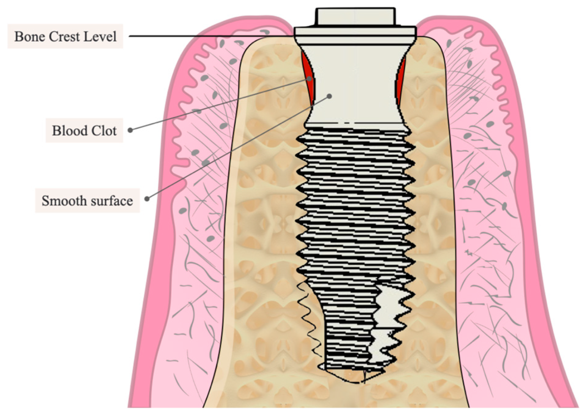 Peri-Implant Tissue Stability: A Series of Five Case Reports on an 