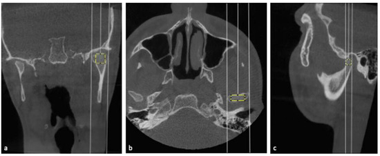 Fractal Dimension of the Condylar Bone Structure in Patients with  