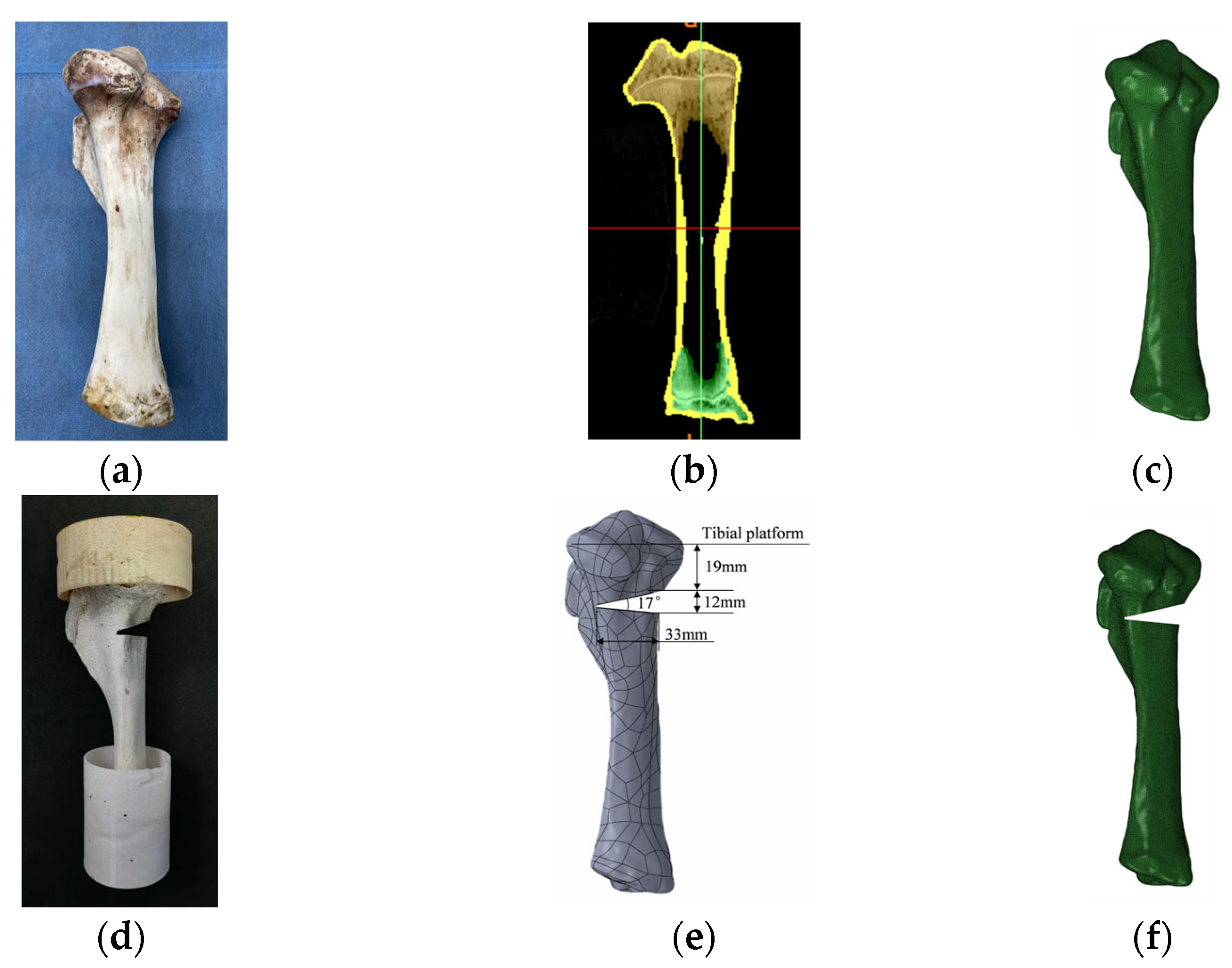 The Effect of Stress Distribution on Tibial Implants with a