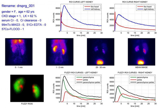 Machine Learning for Chronic Kidney Disease Detection from