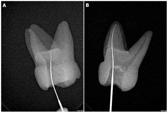 Impact of Visual Magnification on MB2 Canal Detection in a Laboratory ...
