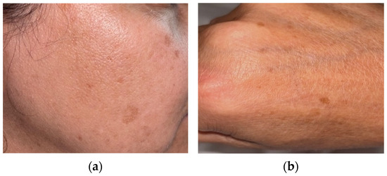 Innovative Skin Depigmenting Strategies: A Review