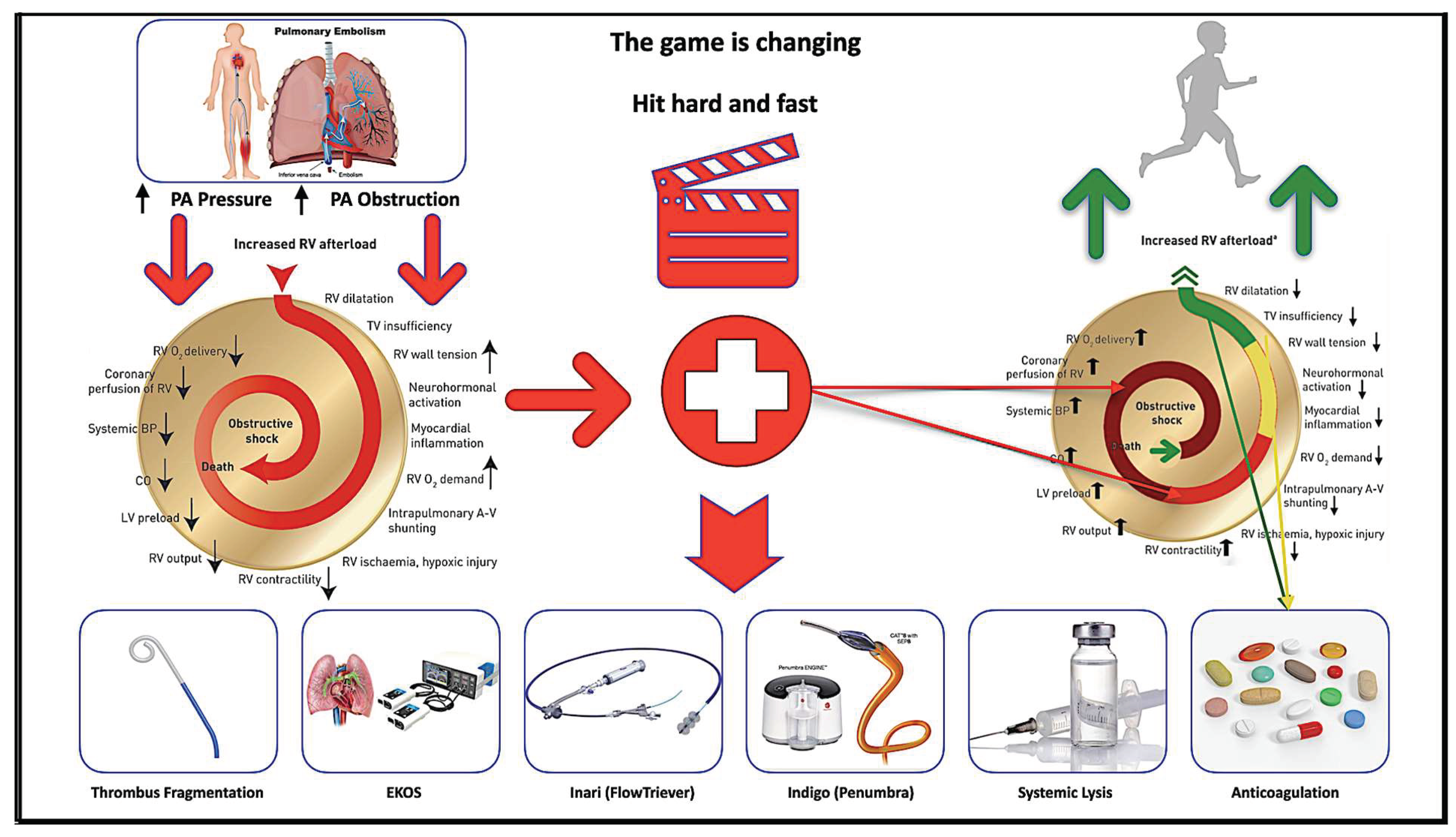 Using a Fibrinolysis Delivery Catheter in Pulmonary Embolism 