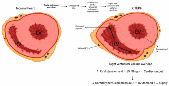 Molecular Pathophysiology of Chronic Thromboembolic Pulmonary ...