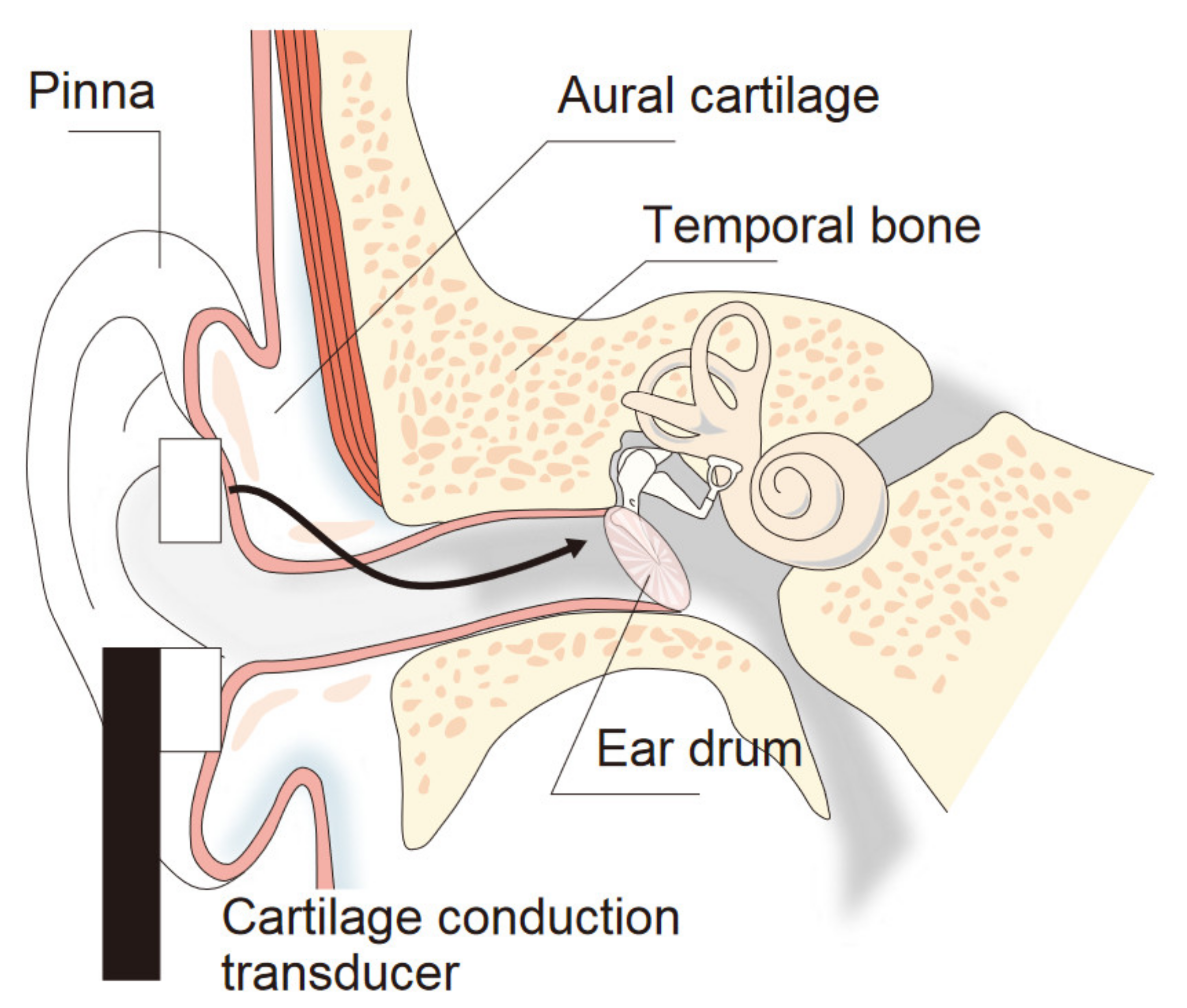 Audiology Research Free FullText Vibrational and Acoustical