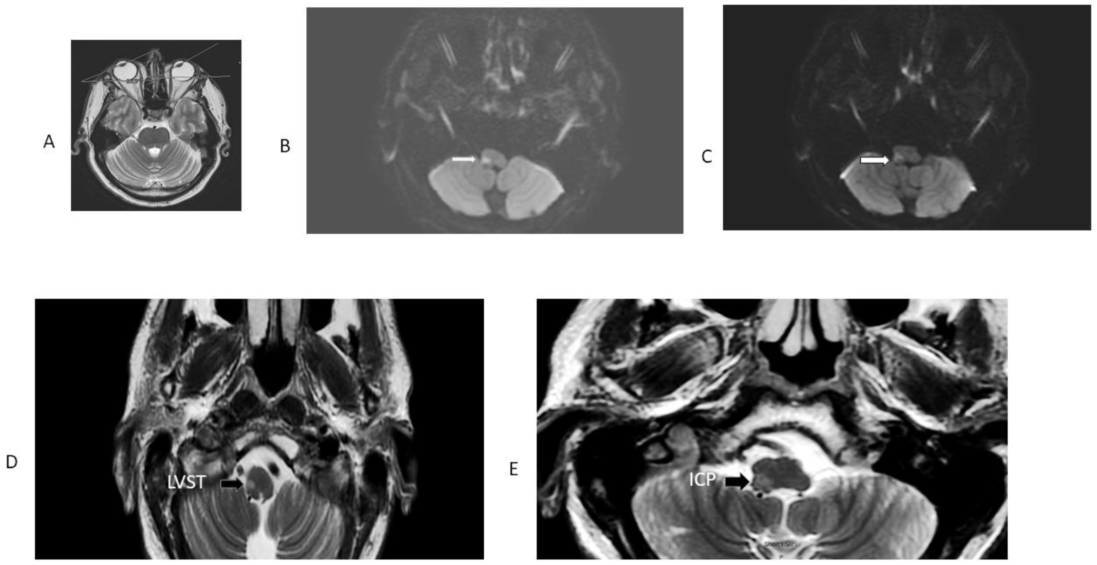 Concordant GRADE-3 Truncal Ataxia and Ocular Laterodeviation