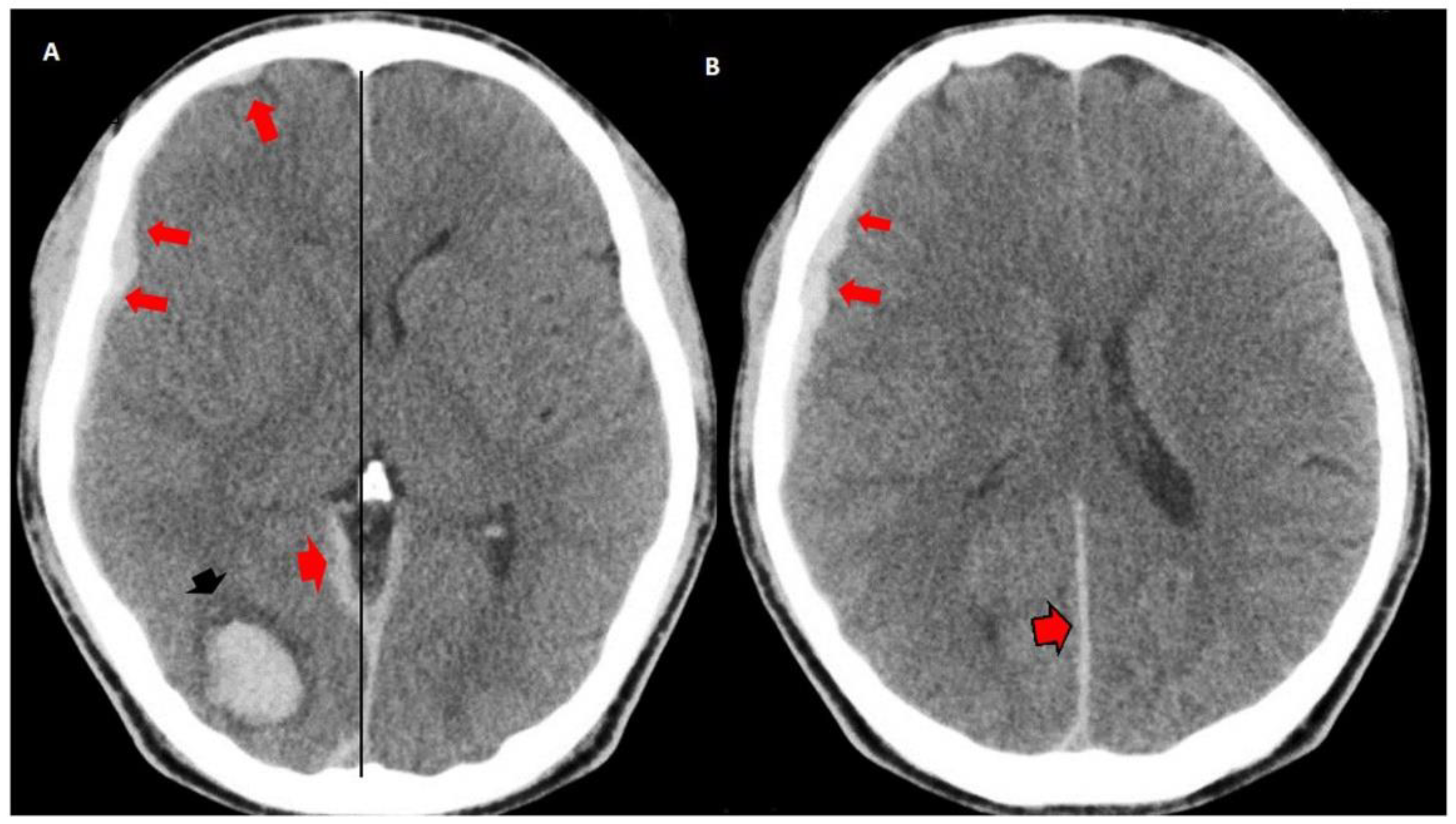icd 10 code for right parietal occipital scalp hematoma