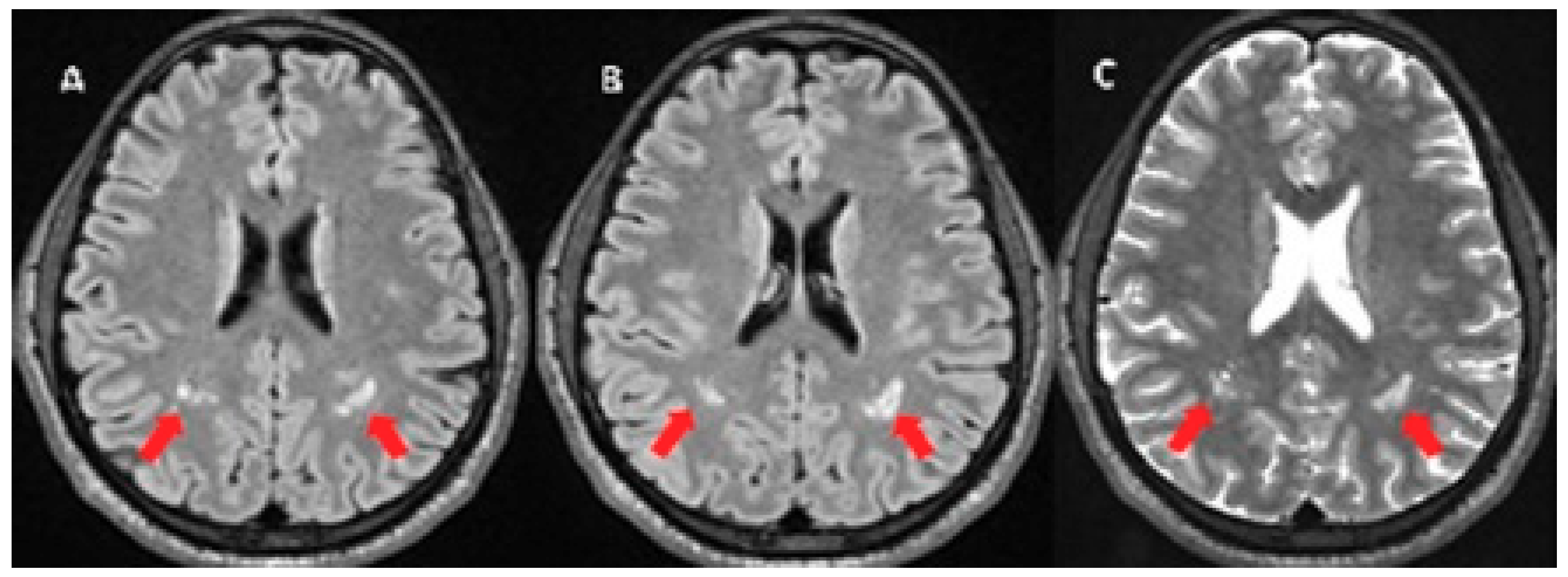 Behavioral Sciences | Free Full-Text | Cerebral Small Vessel Disease
