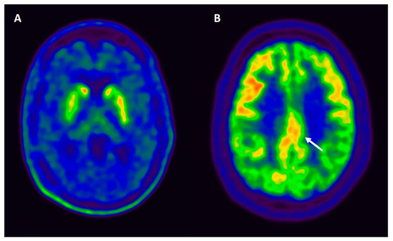 Behavioral Sciences | Free Full-Text | Lewy Body Dementias: A Coin with